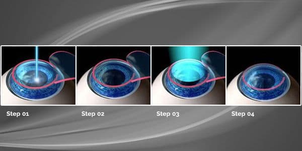 Advanced LASIK Steps